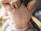 चिकनपॉक्स (Chickenpox)