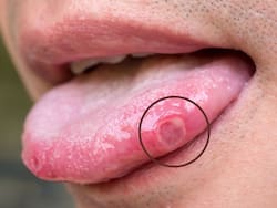 Mouth Ulcer Treatment: बार-बार मुंह में छाले क्यों पड़ जाते हैं, जानिए छाले होने पर क्या न करें और आसान घरेलू उपचार