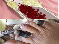 Peripheral Vascular Disease Is Commonly Seen In Diabetics: Get To Know More