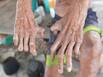What New Can Be Done To Treat Leprosy?