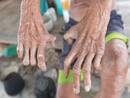 What New Can Be Done To Treat Leprosy?