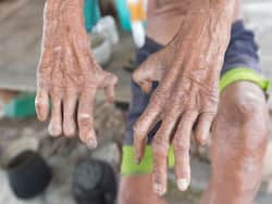 What New Can Be Done To Treat Leprosy?