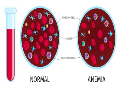 More Than 60% Of India’s Children And Women Are Anemic | TheHealthSite.com