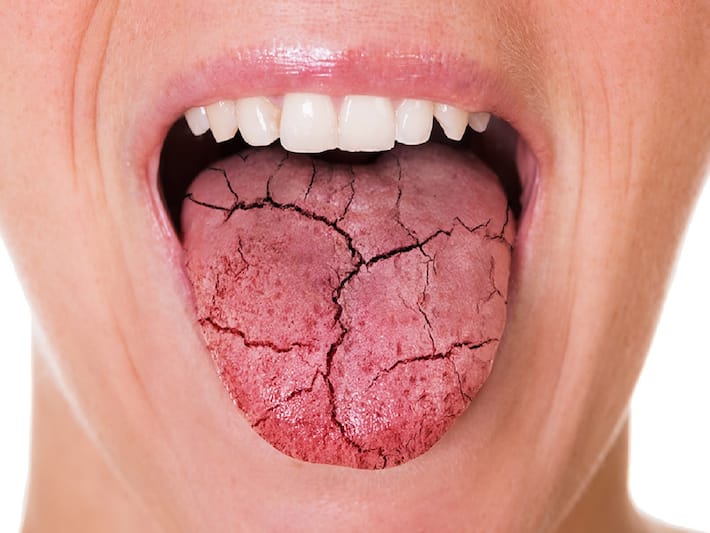 Polydipsia, Dry Mouth, And More Symptoms Of Type2 Diabetes That Show