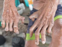 World Leprosy Day 2022: India On Track To Achieve Zero Leprosy Cases By 2030