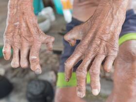 World Leprosy Day 2022: India On Track To Achieve Zero Leprosy Cases By 2030
