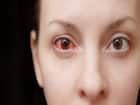 कंजंक्टिवाइटिस (Conjunctivitis)