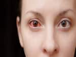 कंजंक्टिवाइटिस (Conjunctivitis)