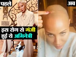 ये मशहूर एक्ट्रेस इस रोग की वजह से सालभर में हुई 'गंजी', जानें किस रोग की वजह से कम उम्र में लोग हो रहे गंजे