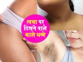 Black Spot On Skin: अंडरआर्म और जांघों में काले धब्बों को न करें नजरअंदाज करने की भूल, इस गंभीर बीमारी का है संकेत