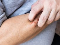 Why Does Pityriasis Rosea Keep Coming Back?