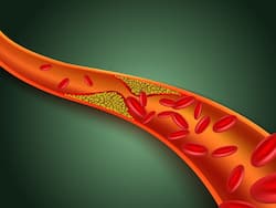 बॉर्डरलाइन कोलेस्ट्रॉल: जानिए शरीर में कोलेस्ट्रॉल की कितनी मात्रा को माना जाता है Borderline Cholesterol, इसमें सावधानी क्यों जरूरी है?