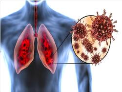 This Old Drug May Protect Against Lung Injury, Blood Clots In Severe COVID-19