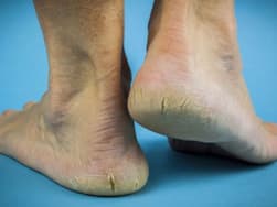 फटी एड़ियां हैं विटामिन की कमी का संकेत, जानिए किस विटामिन की कमी से स्किन हो जाती हैं खराब