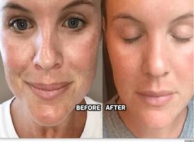 5 Treatments To Look Your Best On Valentine   s Day