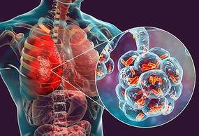 Recurrent Chest Infections: Causes, Symptoms, Risk Factors and More