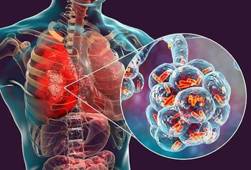 What Causes Recurrent Chest Infections