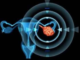 How Ovarian Cancer Hides From The Body's Immune System: The Secret Hideouts Uncovered