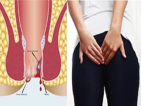 Mumbai-Based Ayurvedic Surgeon Receives Patent For Innovation In Fistula Treatment