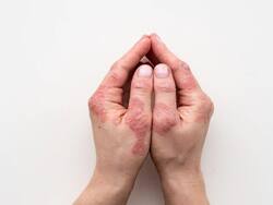 Cold, Dry Air Can Cause Atopic Dermatitis Flare-Ups: Tips To Minimize The Risk