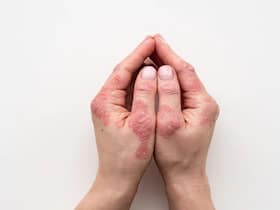 Cold, Dry Air Can Cause Atopic Dermatitis Flare-Ups: Tips To Minimize The Risk