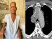Lung Cancer Can Cause Superior Vena Cava Syndrome: A Case Study