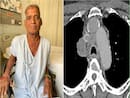 Lung Cancer Can Cause Superior Vena Cava Syndrome: A Case Study