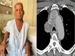 Lung Cancer Can Cause Superior Vena Cava Syndrome: A Case Study