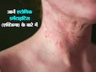 एक्जिमा (Eczema)