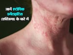 एक्जिमा (Eczema)