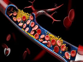 Mind Your LDL Levels! Even Borderline Cholesterol Can Trigger Health Problems