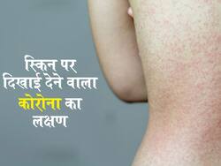 महीनों तक आपको परेशान कर सकता है आपकी स्किन पर मौजूद कोविड का ये लक्षण, जानें कौन सा लक्षण है ये