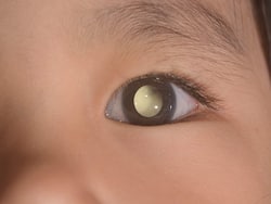 Children   s Eye Cancer: What To Know About It?
