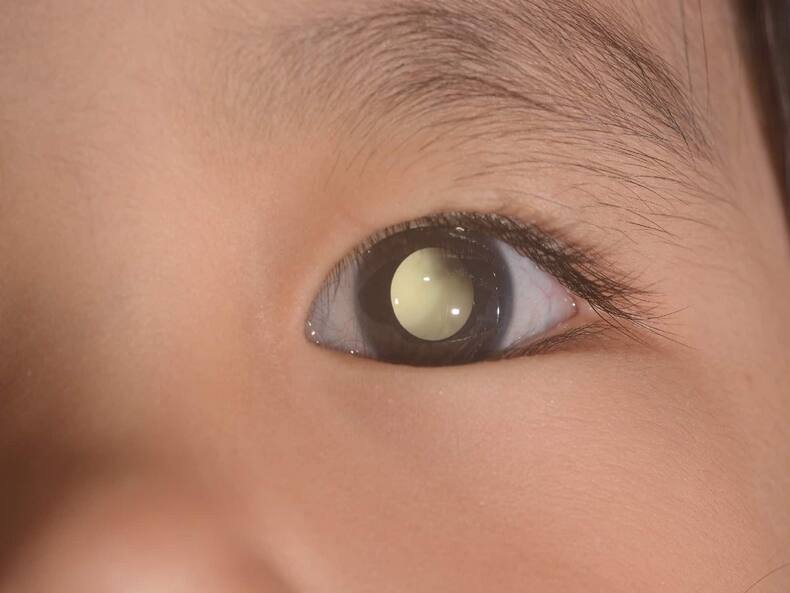 Type Of Cancers In Children: Leukemia, Wilms Tumor And 6 More Common Malignancies That Affect Kids