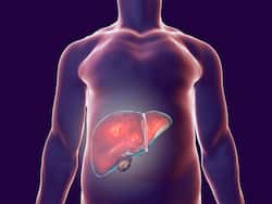 35% Indians Suffer From Fatty Liver Disease; Symptoms You Should Know About