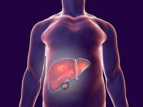 35% Indians Suffer From Fatty Liver Disease; Symptoms You Should Know About 35% Indians Suffer From Fatty Liver Disease; Symptoms You Should Know About