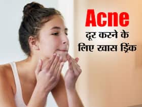 Herbal drinks for acne: इन 5 हर्बल ड्रिंक्स का सेवन चंद दिनों में गायब कर देगा चेहरे से मुंहासे, बेदाग चेहरे के लिए जानें सेवन का तरीका