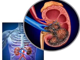 World Cancer Day 2022: All About Renal Cell Carcinoma, A Deadly Cancer That Mostly Affects Men