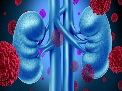 Kidney Cancer: Types, Symptoms, Diagnosis And Treatment | TheHealthSite.com