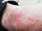 लाइकेन प्लेनस (Lichen planus)