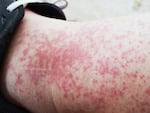 लाइकेन प्लेनस (Lichen planus)