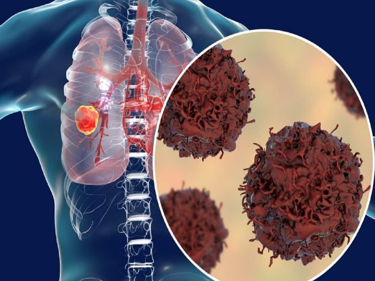 Lung Most cancers: Know About Biomarker Testing, Remedy Choice, Focused Remedy And Extra