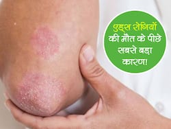 टीबी से नहीं बल्कि इस बीमारी की वजह से जाती है एड्स रोगियों की सबसे ज्यादा जान! जानें कौन सी है ये बीमारी