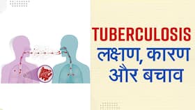 World TB Day 2022: खांसी के अलावा भी हैं टीबी के कई लक्षण, एक्सपर्स से जानें कैसे करें इस बीमारी से बचाव World TB Day 2022: खांसी के अलावा भी हैं टीबी के कई लक्षण, एक्सपर्स से जानें कैसे करें इस बीमारी से बचाव
