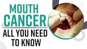 Explained: Why Mouth Cancer In India Is On A Sudden Rise? Causes And Treatment, Expert Speaks