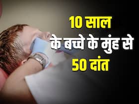 10 साल के बच्चे के मुंह में थे 50 दांत, ढाई घंटे के ऑपरेशन से में 30 दांतों को निकाला