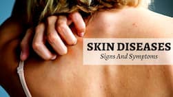 Scaly Patches To Burning Sensation: Beware of THESE 5 Warning Symptoms of Severe Skin Diseases