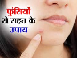 त्वचा पर दिखायी दे रही हैं लाल रंग की फुंसियां तो आजमाएं ये नेचुरल उपाय, कम होगी समस्या
