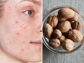 Nutmeg For Acne Treatment: जायफल से मुंहासे का उपचार कैसे करते हैं, एक्सपर्ट से जानिए मुंहासे में जायफल का उपयोग कैसे करते हैं?
