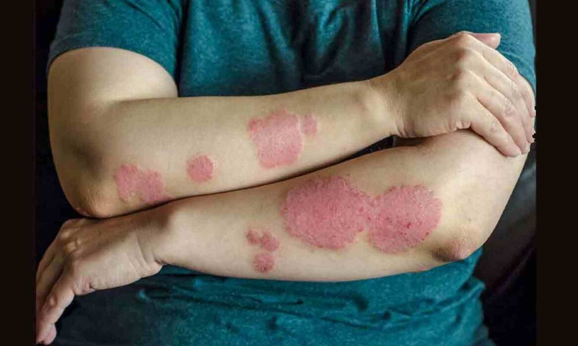 Scaly Patches To Burning Sensation: Beware of THESE 5 Warning Symptoms of Severe Skin Diseases